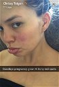 Copertina di Chrissy Teigen dice addio (con un selfie) alla sua pelle perfetta
